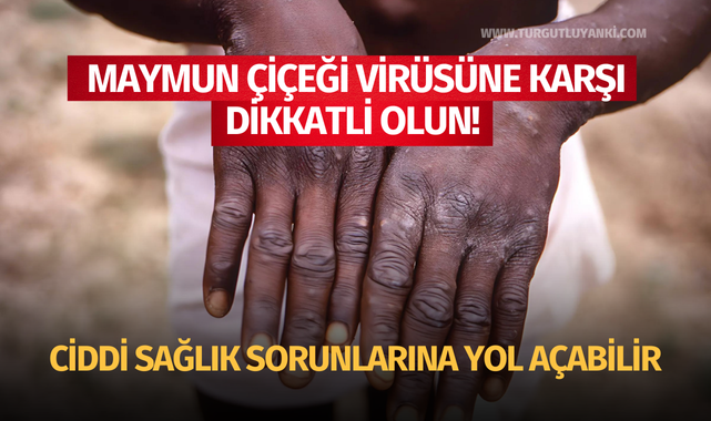 Maymun çiçeği virüsüne karşı dikkatli olun! Ciddi sağlık sorunlarına yol açabilir